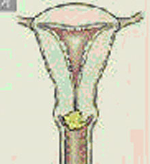 자궁경부암 1기